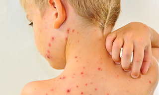 Ciri Ciri Penyakit Rubella Pada Anak - Ini Cirinya